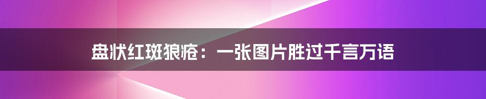 盘状红斑狼疮：一张图片胜过千言万语