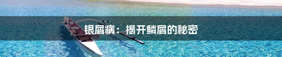 银屑病:揭开鳞屑的秘密